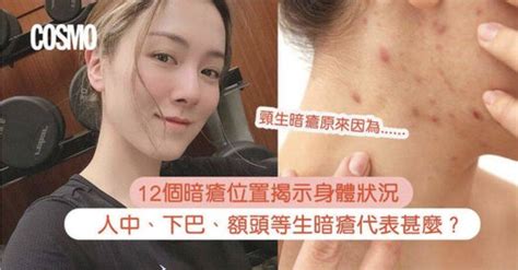 頸後生暗瘡|【暗瘡位置】不同代表什麼？中醫教如何處理及預防